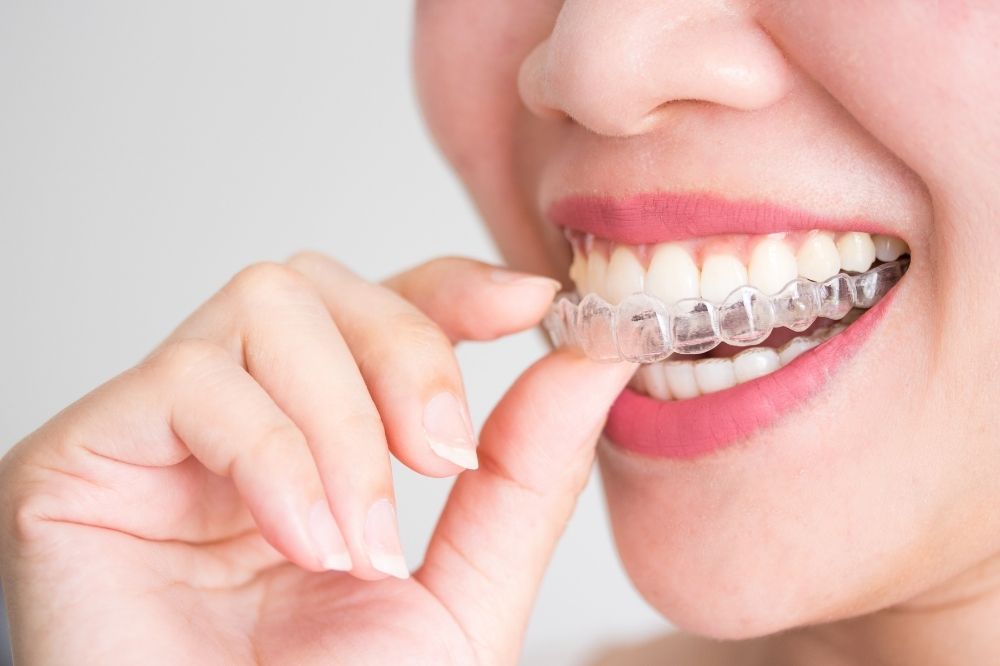 Neden İnvisalign Teen?